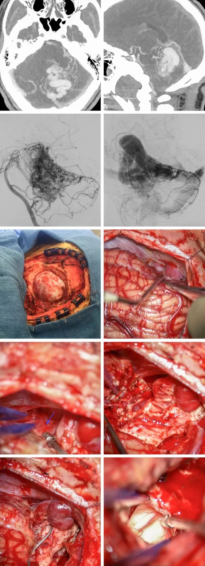 先天性脑血管畸形图片图片