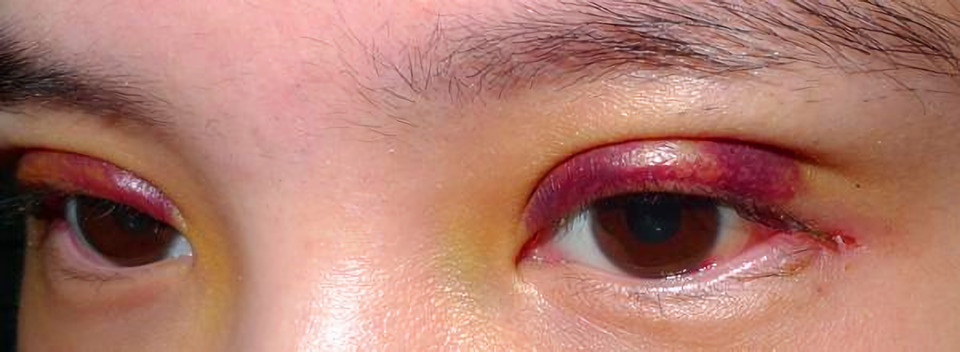 双眼皮术后淤血怎么办