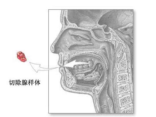 腺样体切除术是儿童中最常见的外科手术腺样体肥大的主要表现是鼻塞