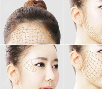 【线雕】改变松垂肥脸,提出紧致小v脸