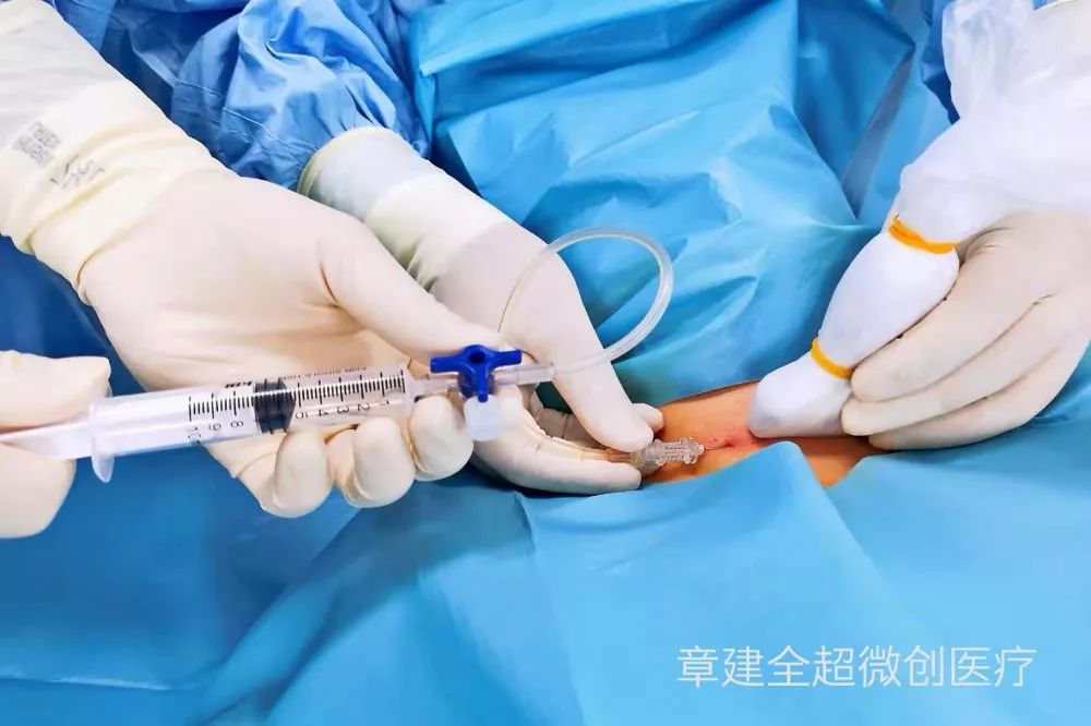 坚持如此"高规格"的甲状腺穿刺活检究竟是为啥?