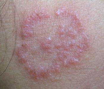 应激反应,变得越来越厚,越来越粗糙,原本可能只是简单的瘙痒或者皮炎