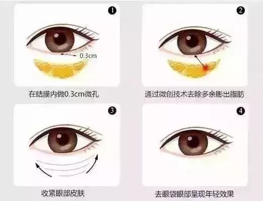 此外,去眼袋时并不是平均去除三侧的脂肪量 而是根据求美者的眼部情况