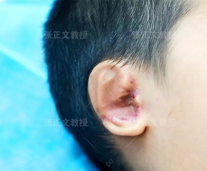 祛除包扎的纱布后,会发现再造的"耳朵"肿胀,清晰的耳朵轮廓都看不见了