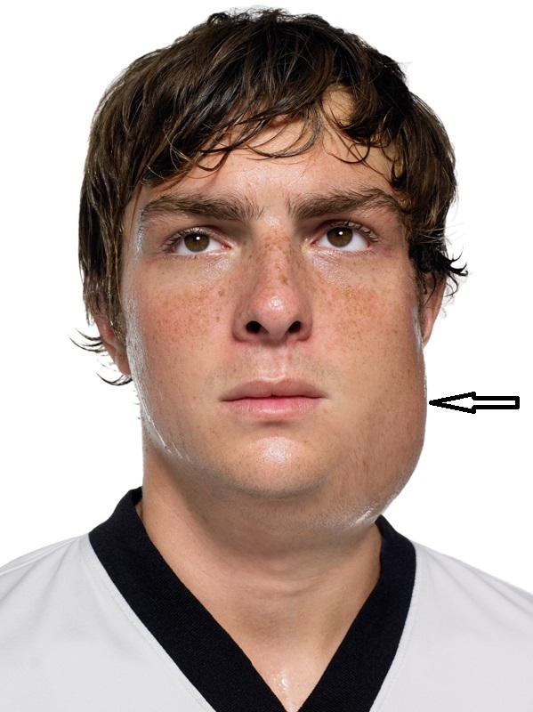 脸肿痄腮腮腺炎