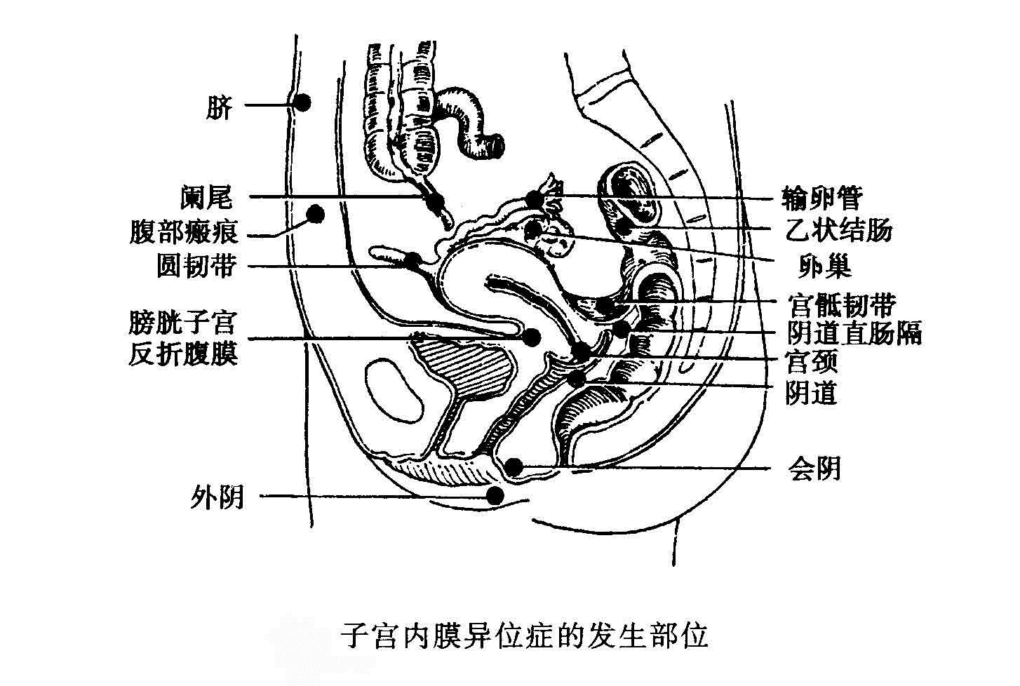 检查发现卵巢子宫内膜异位囊肿 怎么办?