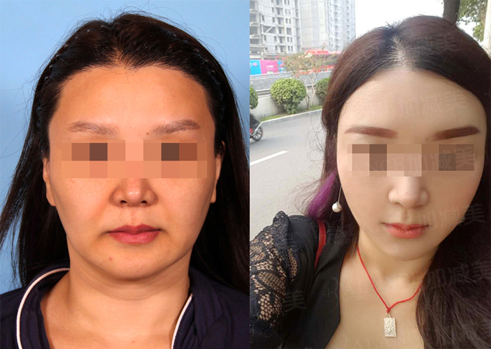 面部提升:v美减龄,线雕,拉皮有什么不同?