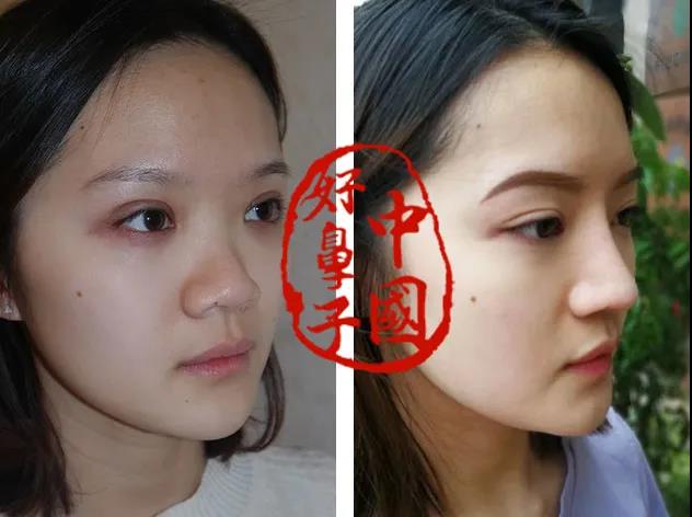 综合隆鼻,是最适合中国人的隆鼻方式.
