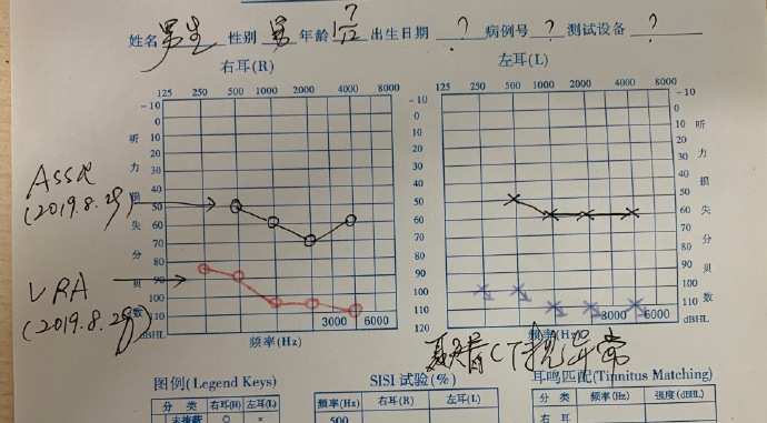 复查多频稳态听觉诱发反应assr后,得出与以前相似的结果.天地之别也.