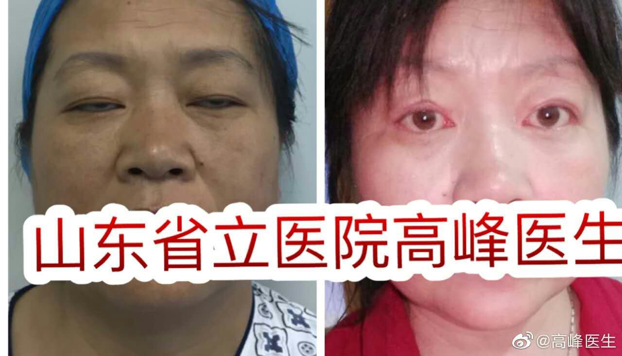 重度上睑下垂,肌无力 应用额肌瓣术后一年 有点小瑕疵,但是眼睛又大又