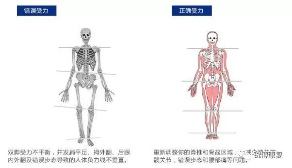 与此同时,它还会造成膝关节内扣与下肢力线偏移,进一步引发一系列的