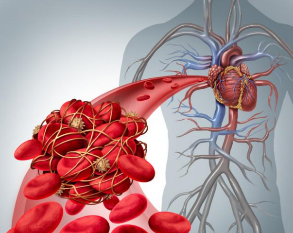 动脉粥样硬化吃药能彻底逆转吗?辟谣:做好这两点更重要