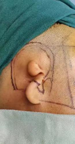 【耳再造案例故事】为了这双耳朵,他盼了40年