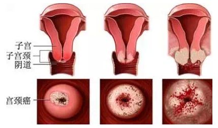 母亲宫颈癌子宫全切,女儿宫颈病变2级,宫颈癌难道遗传吗?