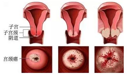 宫颈癌病变过程图片图片