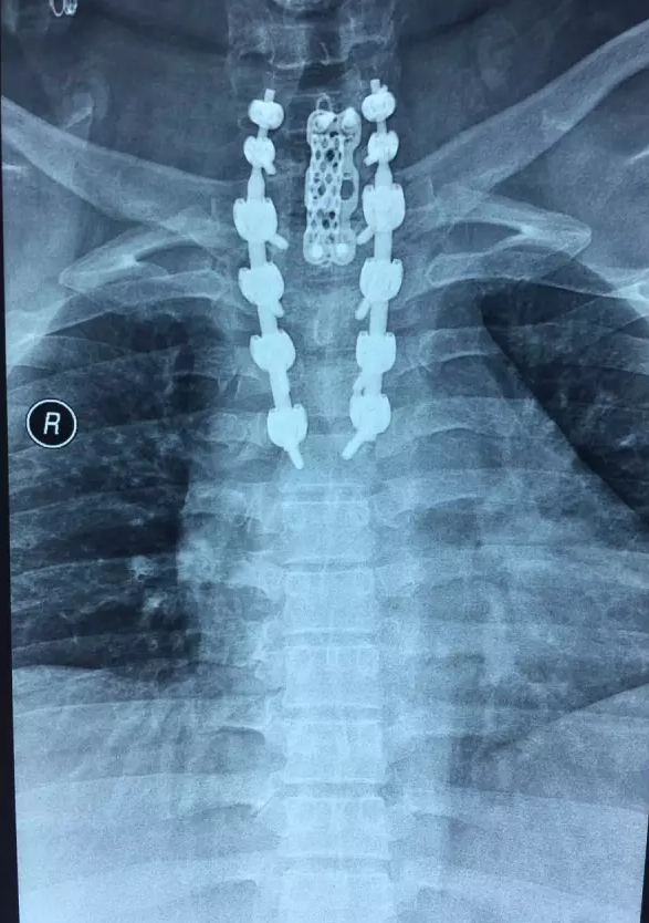 经验分享颈椎,胸椎骨折虽然只是常规手术,但患者受伤部位于颈胸节段
