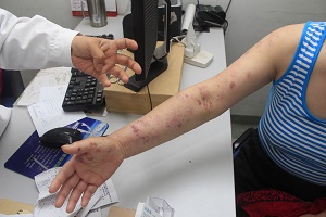 "缠腰龙"缠腰一圈会死人,这不是真的!-刘彦春主任医师-爱问医生