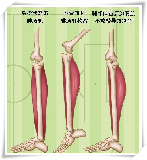 發生在小腿和腳趾的肌肉痙攣最常見,發作時疼痛