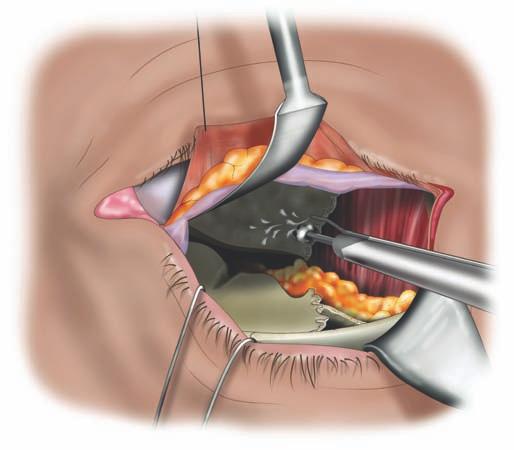 眼眶减压手术并发症——甲亢突眼那些事儿