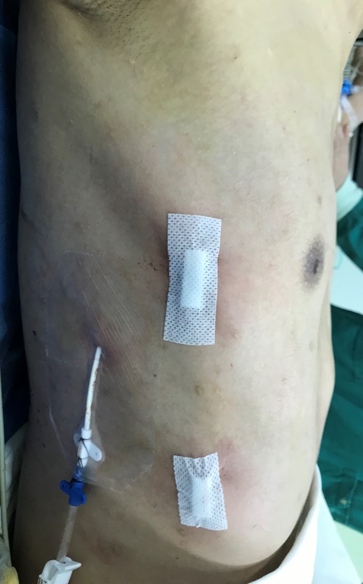 今天的wenlin手术:桶状胸的微创治疗方法