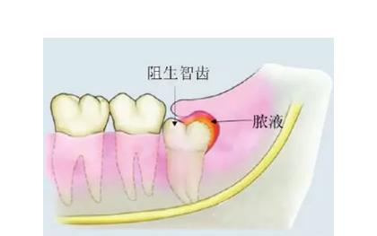 危害一:智齿冠周炎01智齿的危害包括请看下图,我们来讲一讲智齿的危害