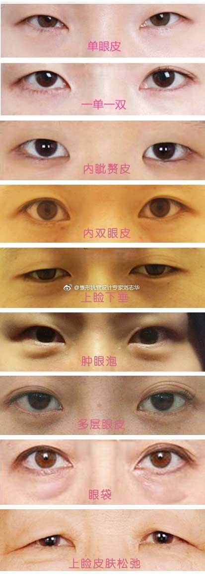 双眼皮手术可以解决哪些问题?