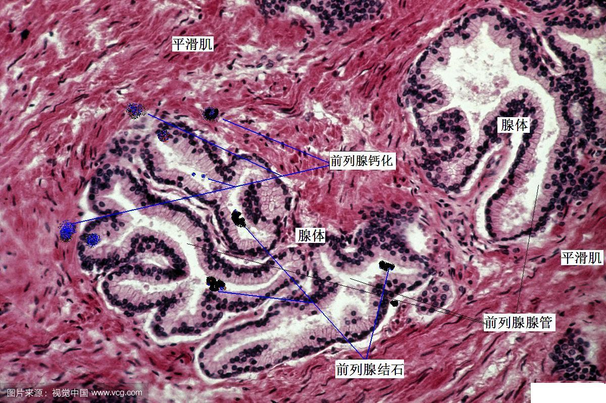 前列腺镜下图片图片