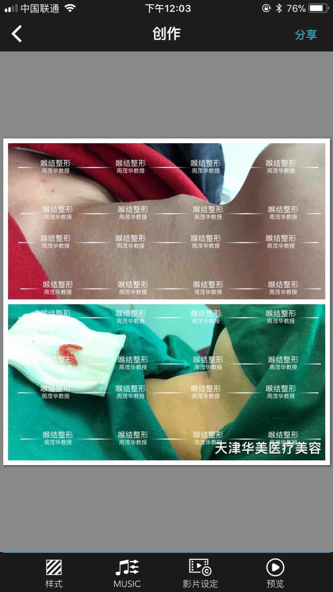 喉结整形成功完成1000例