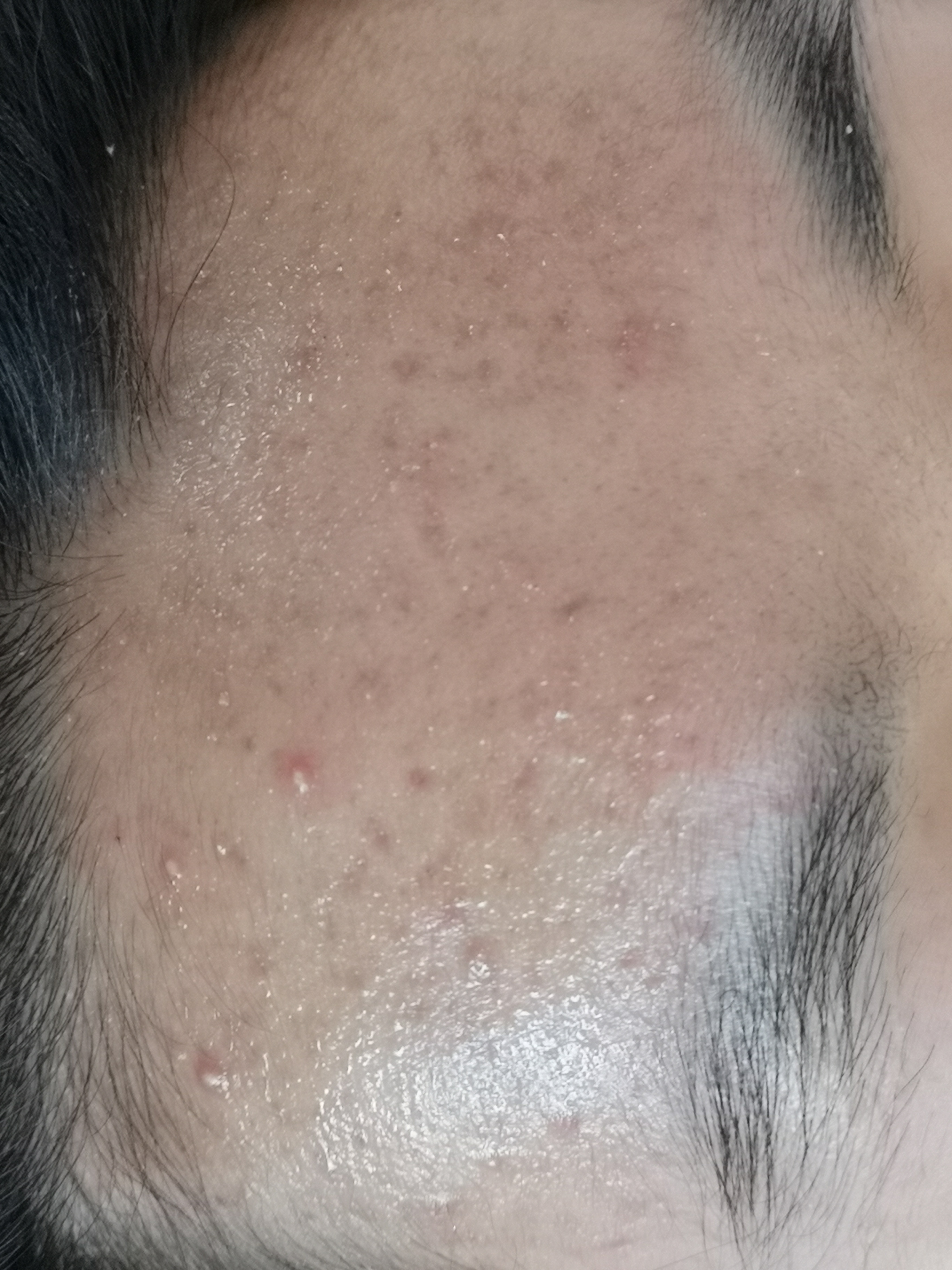 挤痘痘的正确打开方式
