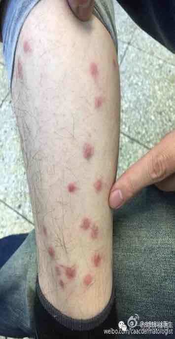 虫咬皮炎也叫丘疹性荨麻疹有时候是特别的瘙痒