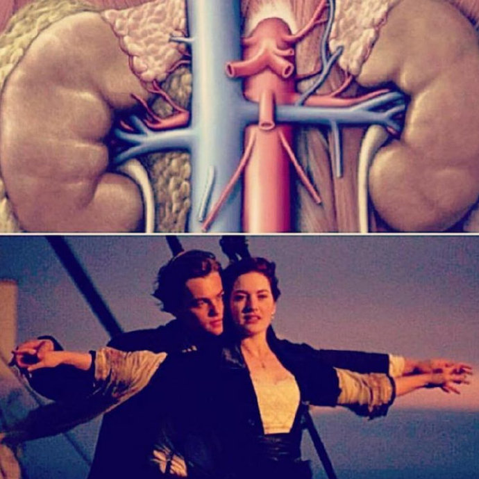 病例分析什么是胡桃夹综合征左肾静脉压迫综合征