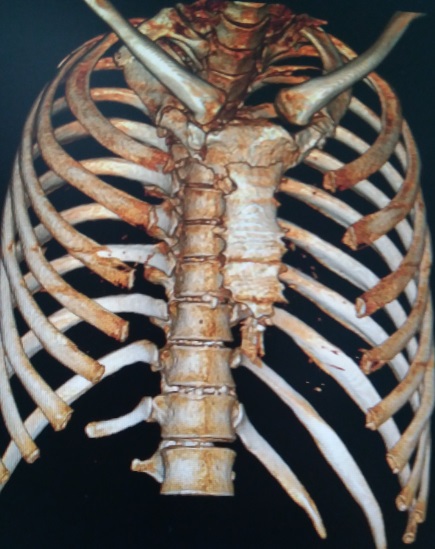 胸椎凹陷的图片图片