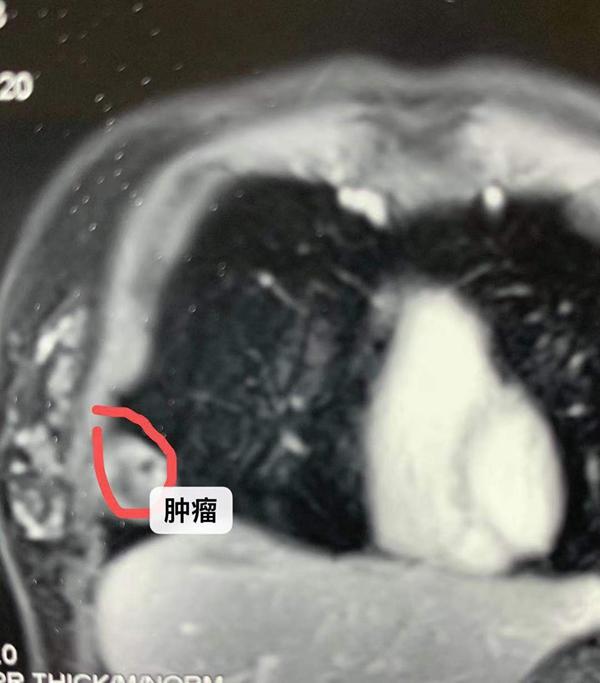 年輕女孩肋骨間發現腫瘤,三公分小切口,保住了胸部美觀