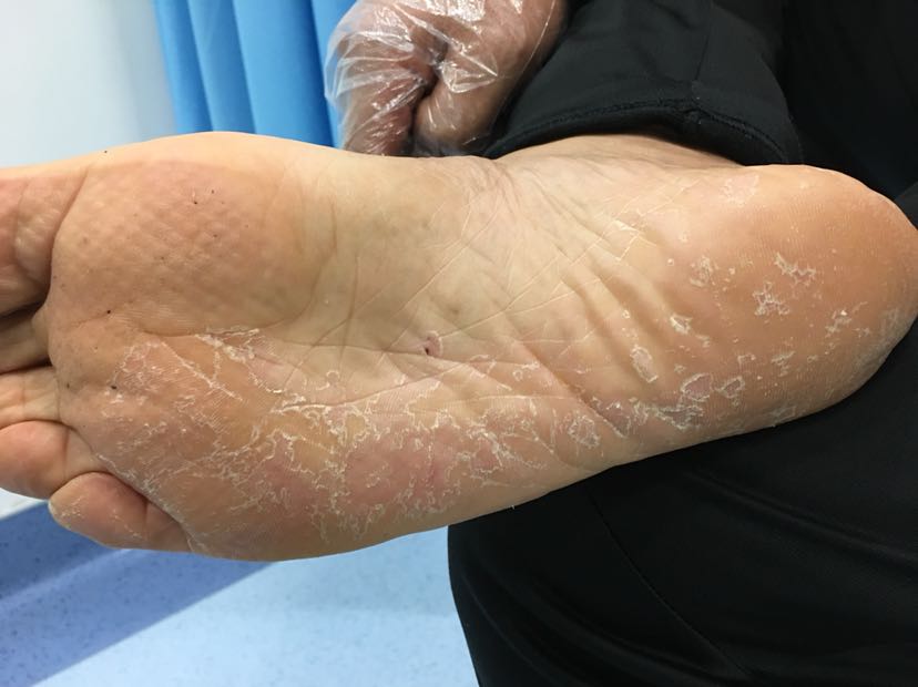 你现在脚像他一样干裂,脱皮瘙痒的厉害,不方便来医院能在家里怎么办呢