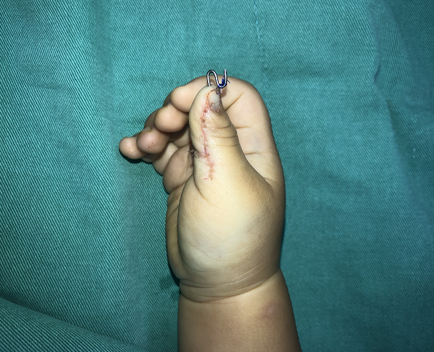 多指手术是要全麻吗麻醉对宝宝有什么影响