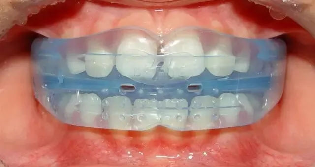mrc肌功能矫治:儿童矫正神器