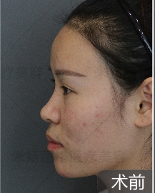 低鼻的解决方案