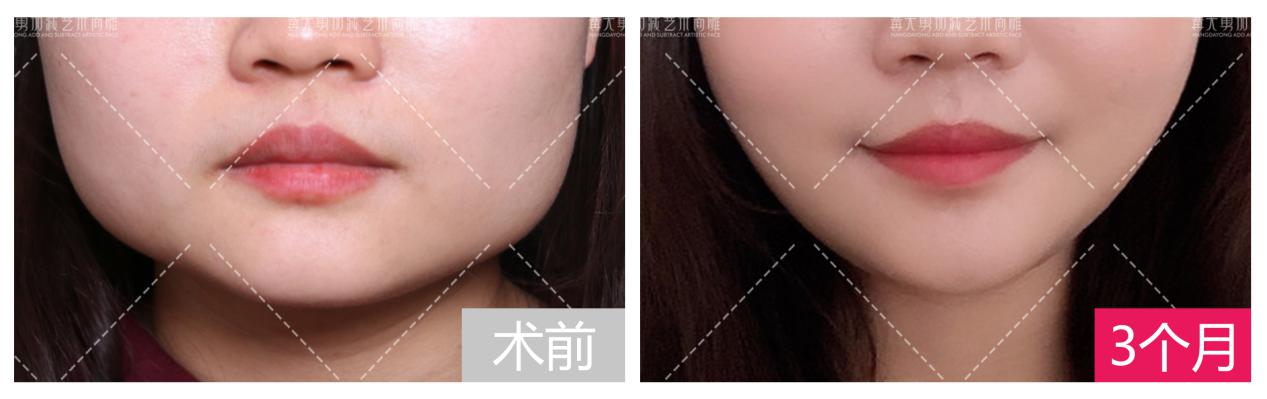 下颌角手术中,可以切除全部咬肌吗?