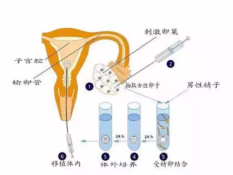 人工授精和试管婴儿的区别