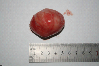 乳腺纤维瘤复发,与手术无关