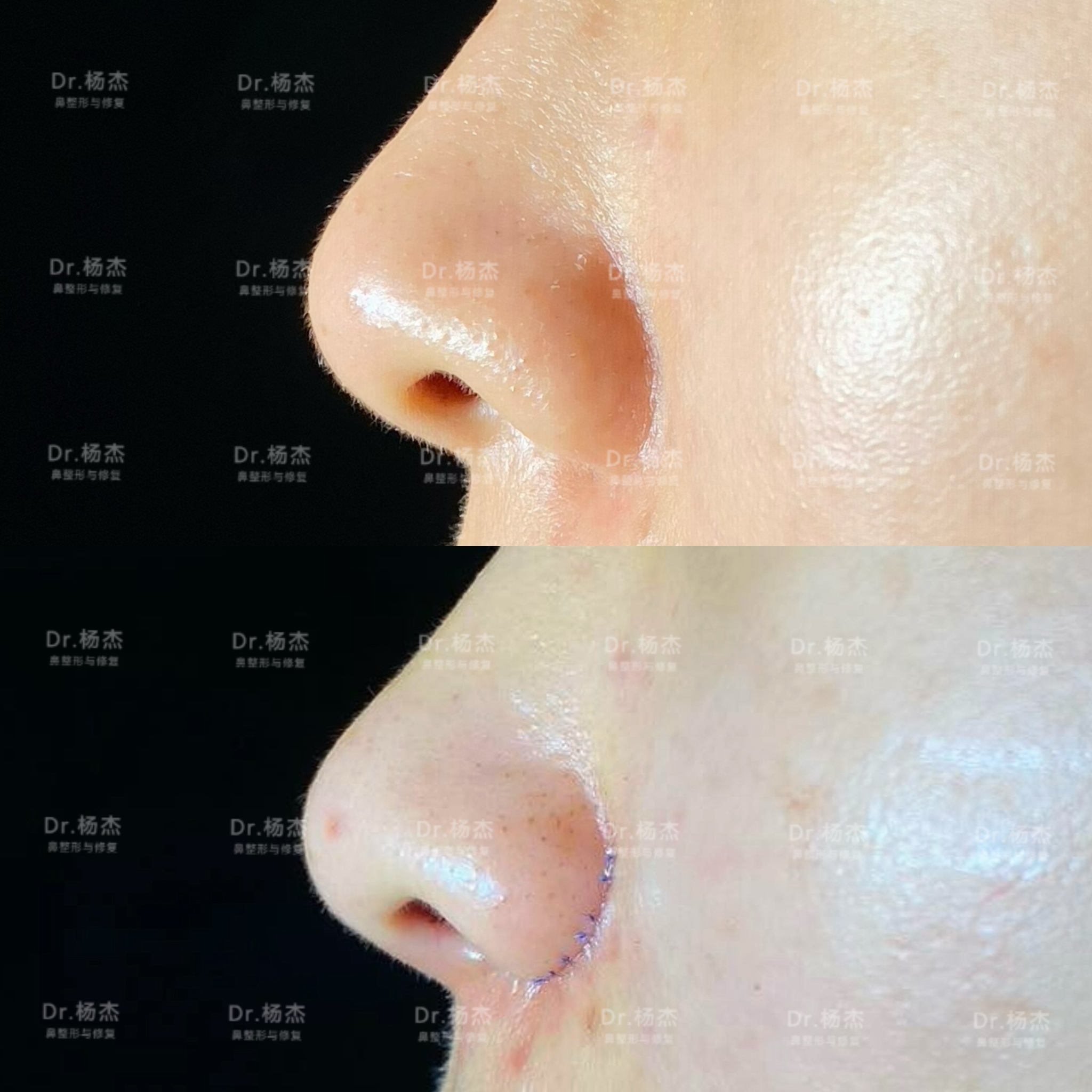 鼻翼缘缺失漏鼻孔修复案例，术后七天对比图分享—深圳李信锋隆鼻整形 - 知乎
