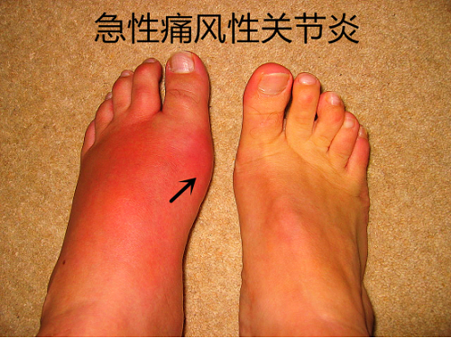 可当天晚上,施老伯就因为脚疼痛难忍去医院急诊了,要问施老伯的脚真的