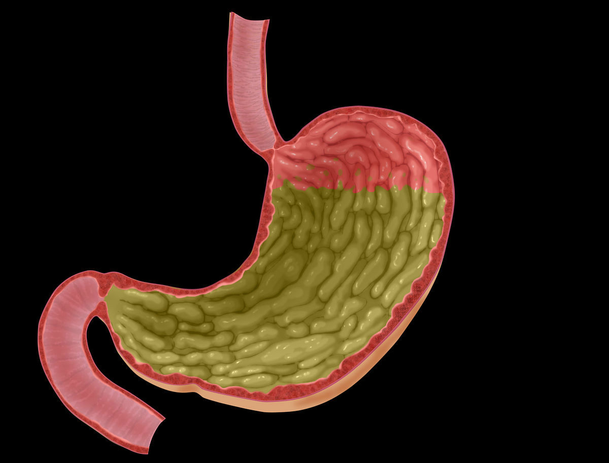 胃癌常常有三个标志出现这个异常提示恶性肿瘤已是进展期