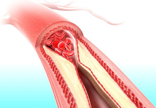 动脉血栓是如何形成的?如何有效预防血栓形成?一文为你全说清