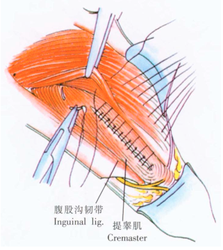 终于可以在尸体上探寻腹股沟区的秘密,这也促使产生了全新的手术方式
