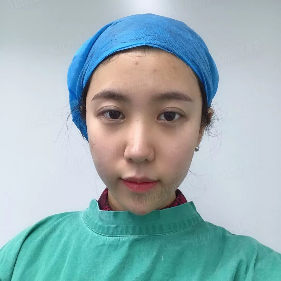 【整形日记】玻尿酸填充案例 | 填个下巴,脸都能小一圈!