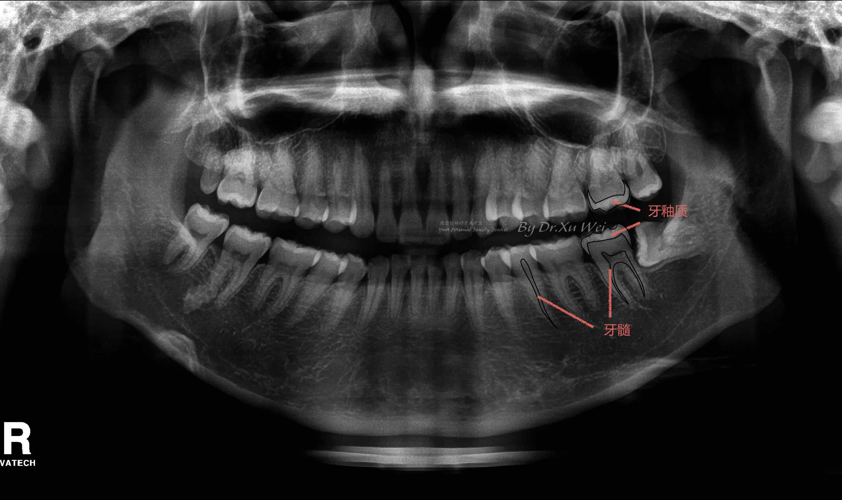 后牙上的"小黑线",留你不留?