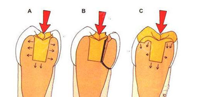 细小的裂纹,可以磨除牙隐裂的地方,用树脂充填,阻止裂缝继续