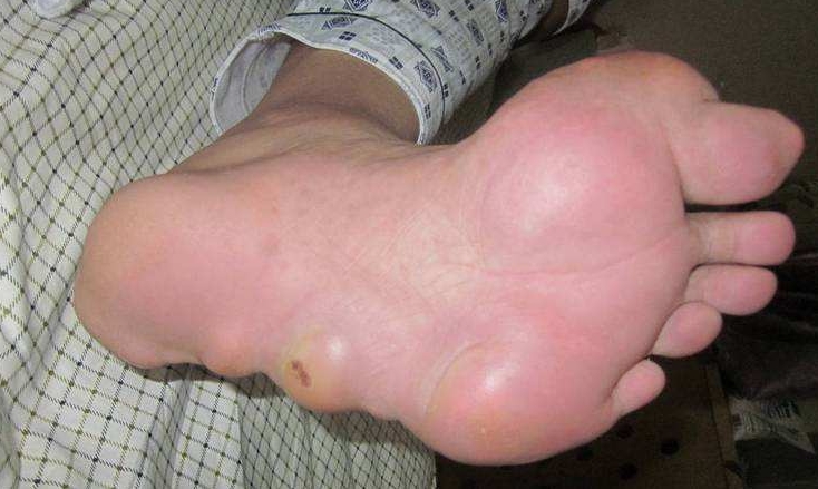 脚底板痛风该怎么办