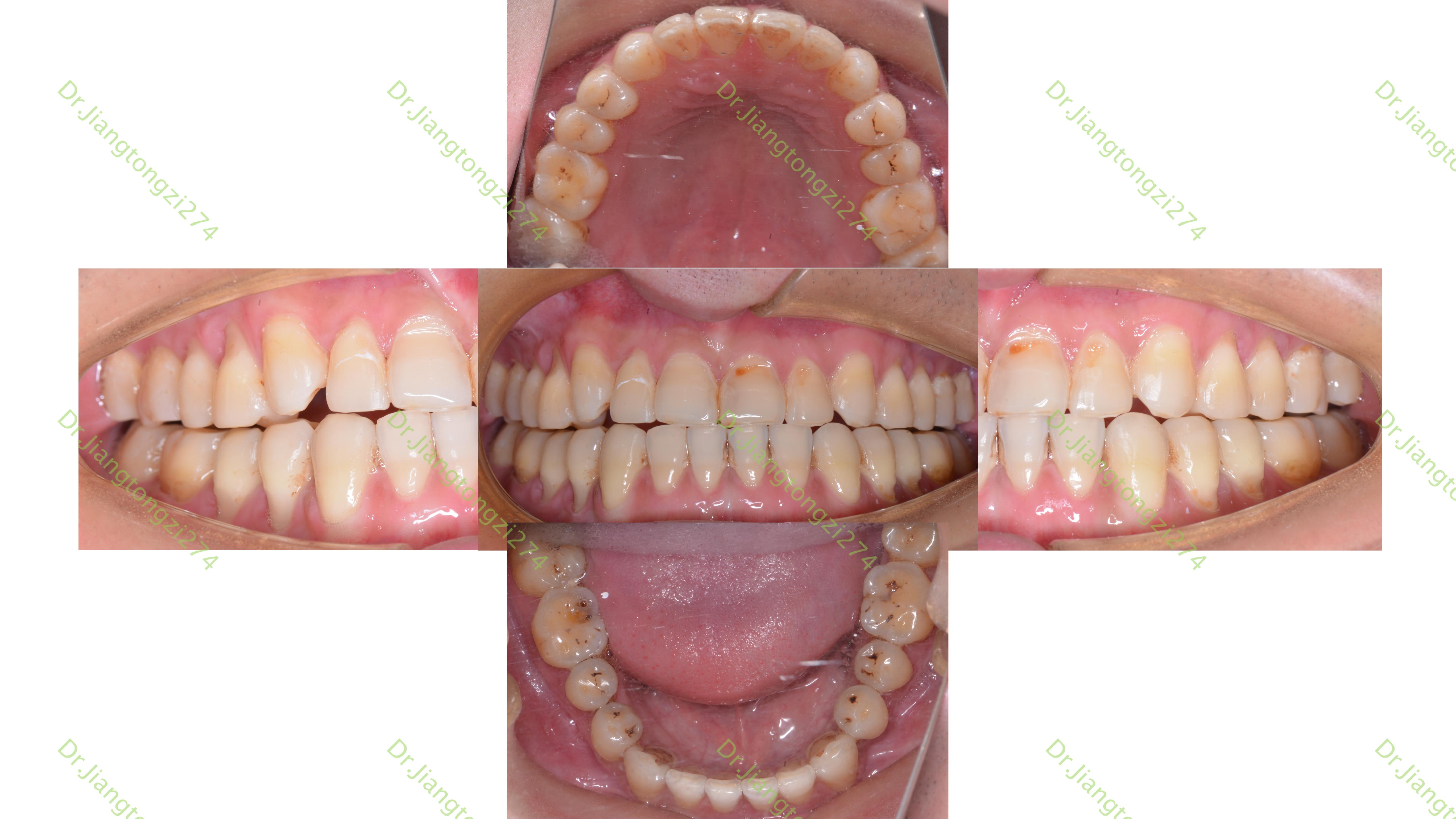 《正畸病例77:成人地包天的隐形矫正》